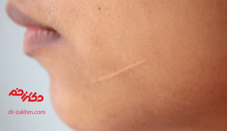 درمان اسکار چیست؟