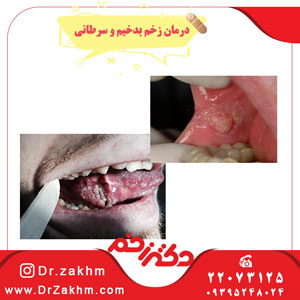 درمان-زخم-بدخیم-و-سرطانی