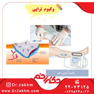 وکیوم تراپی