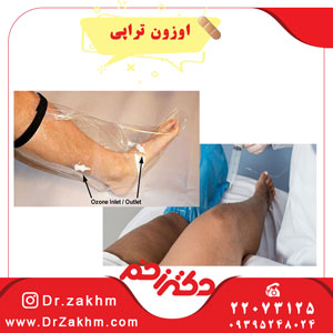 اوزون تراپی