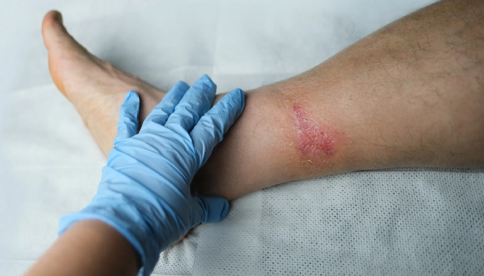 پیشگیری از عفونت زخم چگونه است