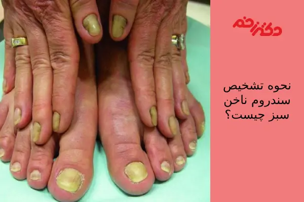 تشخیص سندرم ناخن سبز
