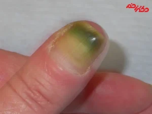 سندرم ناخن سبز